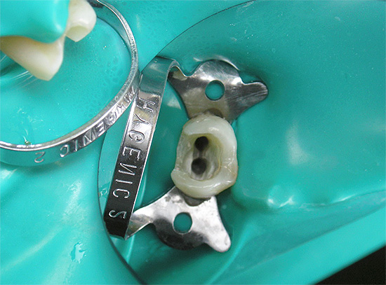Το υλικό πλήρωσης με το οποίο γεμίζονται τα κανάλια ρίζας μετά τον καθαρισμό τους μπορεί να προκαλέσει αλλεργική αντίδραση στους μαλακούς ιστούς που περιβάλλουν το δόντι.