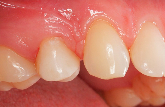 Λόγω της αλλεργίας στο υλικό πλήρωσης, το κόμμι δίπλα σε ένα νεκρό δόντι μπορεί να είναι συνεχώς φλεγμονώδες και κακό.