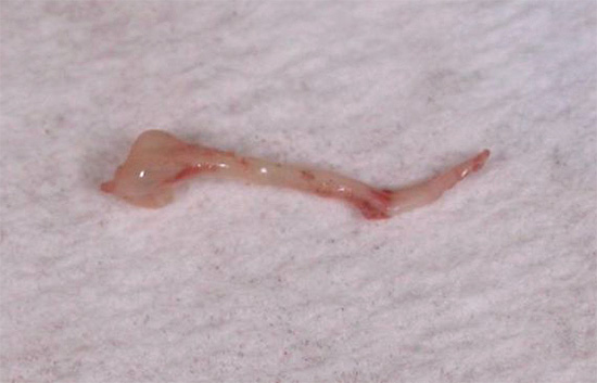 La fotografía muestra el nervio extraído del diente.