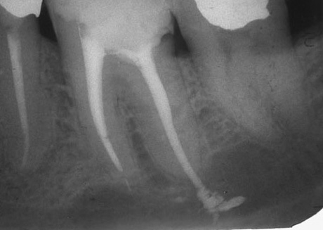 Cuando la inflamación de los tejidos alrededor del material de relleno en el diente es doloroso de morder, y una persona no puede comer adecuadamente.