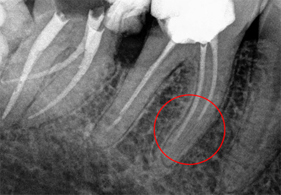 El canal no completamente sellado puede ser una fuente de problemas dentales importantes en el futuro.