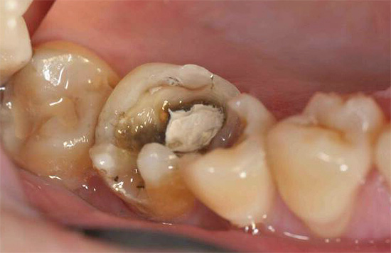 L'installation sur la pâte dévitalisante dentaire à base de composés de l'arsenic comporte des risques considérables ...