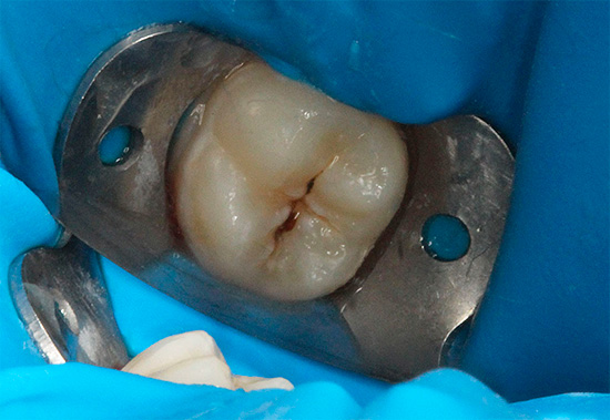 Si la pulpe n'est pas affectée, la dent carieuse est généralement traitée en une visite.