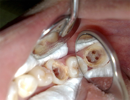 La photo montre clairement les canaux radiculaires de la dent, qui doivent être soigneusement nettoyés et scellés pendant le traitement.