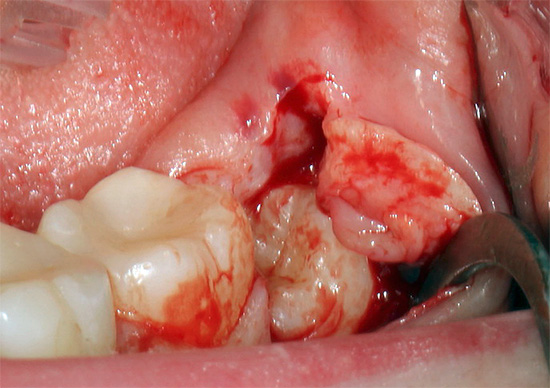 Cette image montre une dent de sagesse dans la section des gencives.