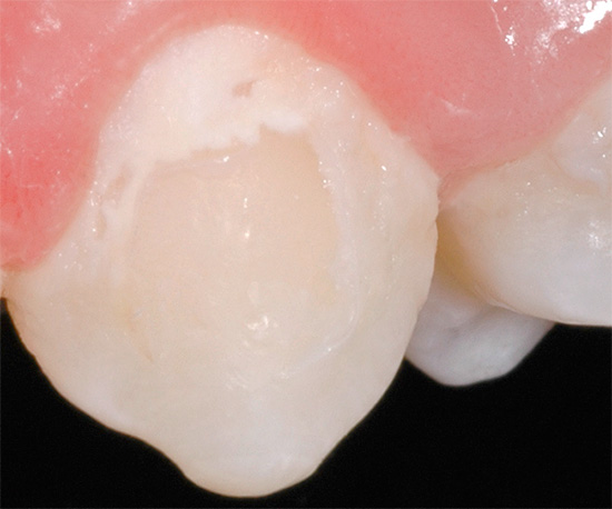 La photo montre un exemple de dent avec des caries au stade des taches.