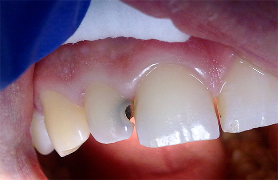 Avec les caries profondes, la dent peut devenir très sensible à une variété de stimuli.