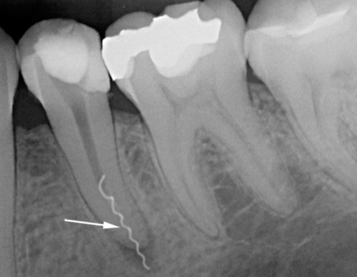 La photo montre clairement un morceau d'instrument dentaire cassé dans le canal radiculaire.