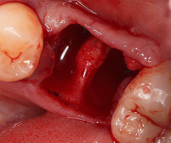 Vediamo quanto a lungo la gomma guarisce dopo la procedura di estrazione del dente e come può accelerare il processo di guarigione ...