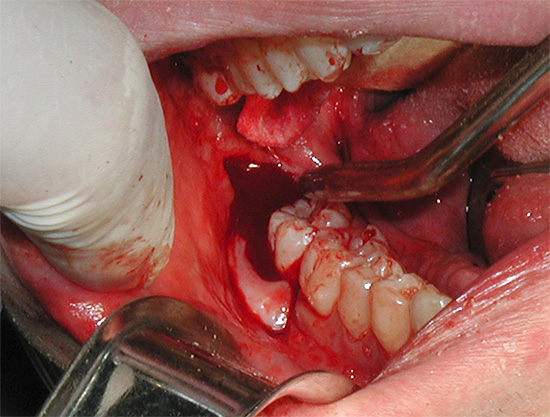 Когато зъбите на мъдростта са трудни за отстраняване, често се случва тежка травма на меките тъкани около нея ...