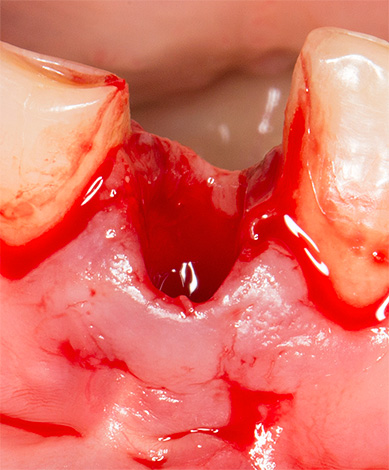 खराब रक्त संग्रह के साथ, दाँत के छेद से बहुत लंबे खून बह रहा है।