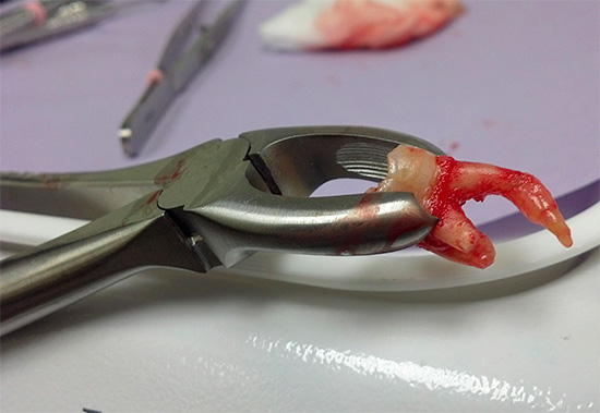 Existem várias maneiras de acelerar o processo de cicatrização após a extração dentária ...