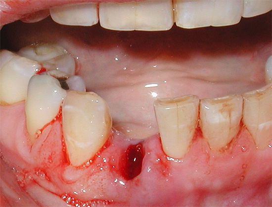 One of the problems faced by patients immediately after tooth extraction is the prolonged bleeding of the hole.