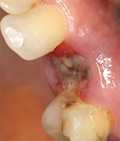 Si les restes cariés d'une dent ne sont pas complètement retirés du trou, la plaie peut s'infecter fortement et guérir très lentement.