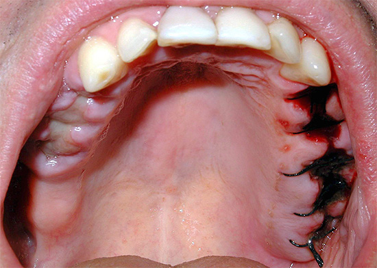 Chăm sóc đúng cách nướu răng bị tổn thương làm giảm đáng kể nguy cơ bị viêm nặng, do các vết thương lành nhanh hơn.