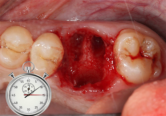 Como regra geral, as bordas gengivais se aproximam do poço por mais de 2,5 semanas após a remoção do dente.