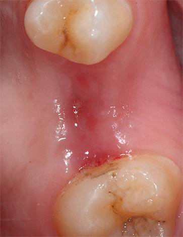 The photo shows almost completely healed gums.