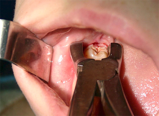 L'extraction dentaire est une sorte d'opération chirurgicale et après, dans certains cas, des complications peuvent survenir ...