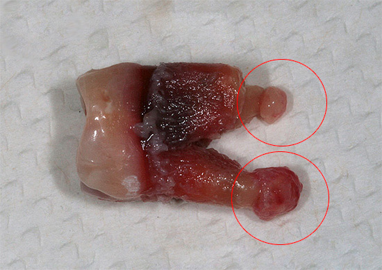 La photo montre une dent avec des kystes sur les racines - si un morceau d'une telle racine reste dans le trou, le patient risque à l'avenir de développer une complication grave ...