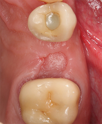 Photo d'un trou dentaire guéri