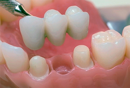 Un tel pont permet de restaurer la fonction d'une dent perdue et d'empêcher la morsure à l'avenir.