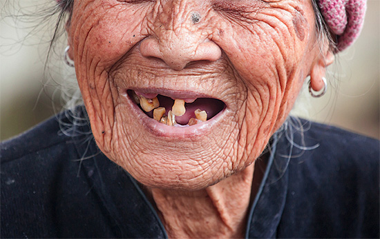 Моля, имайте предвид, че при стари жени, които подбуждат зъбобол (и други заболявания), ситуацията в устната кухина е далеч от най-добрите ...