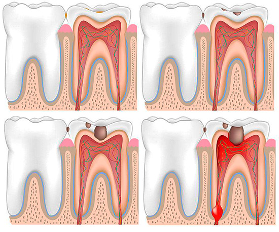 La entrada de bacterias a través de la cavidad cariosa en la cámara pulpar del diente conduce inevitablemente a la inflamación de la pulpa, y este es el mecanismo más particular para el desarrollo de pulpitis aguda.