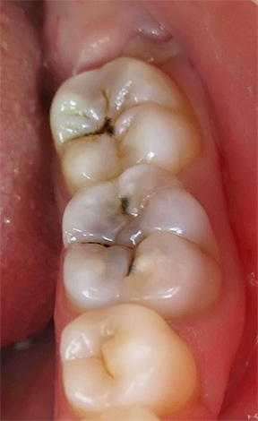 Debido al hecho de que el dolor en la pulpitis aguda purulenta a menudo no tiene una cierta localización, es bastante difícil para un médico sin el equipo adecuado encontrar un diente malo.