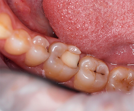 Así es como se ven los dientes, uno de los cuales se ve afectado por la pulpitis aguda, pero ¿cuál?