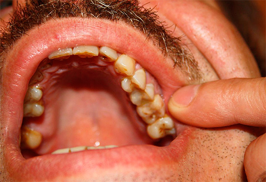 Si el paciente puede indicar con precisión el dolor del diente, en la mayoría de los casos esto corresponde a la forma serosa de pulpitis.