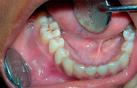 Voor een betrouwbare verlichting van de oorzaken van kiespijn, in veel gevallen zonder tussenkomst van de tandarts zal het niet doen.