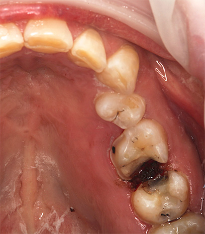 مع هذه الحالة من الأسنان ، من الأفضل ألا ننظر إلى مؤامرة قوية ضد الألم ، ولكن من أجل طبيب أسنان جيد.