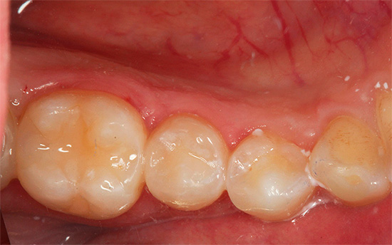 Foto del diente tras el tratamiento e instalación de la junta.