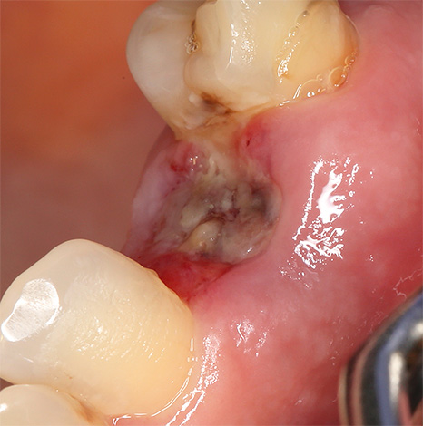 Нека да поговорим за алвеолита - неприятно усложнение, което често се случва след отстраняването на зъбите и се проявява чрез възпаление и зачервяване на дупката, което намалява скоростта на зарастване.