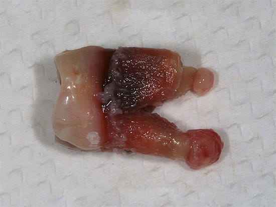 Und dieses Foto zeigt einen echten extrahierten Zahn mit Zysten an den Wurzeln.