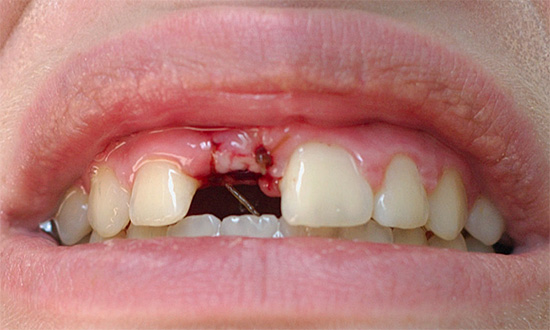 Incluso si el orificio dental después del autotratamiento ha dejado de resecarse, debe consultar a un dentista para que lo asesore.