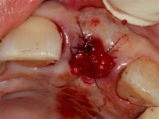 Върху дупката на зъбите се поставят шевове.