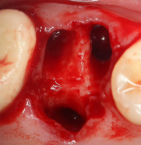 Alveoliti önlemek için, doktorun tavsiyesini ihmal etmeden, diş çekildikten hemen sonra deliğe dikkat etmelisiniz.