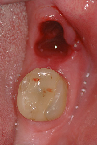 La alveolitis también puede tratarse en el hogar, pero en la mayoría de los casos aún requerirá una visita al dentista.