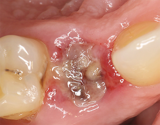 Снимката показва появата на дупката 2 дни след изваждането на зъбите.