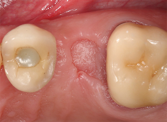 Vollständig verheiltes Zahnfleisch - Aussehen zwei Monate nach der Zahnextraktion.