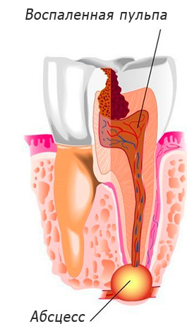 Ein schematisches Beispiel einer Zyste auf der Zahnwurzel