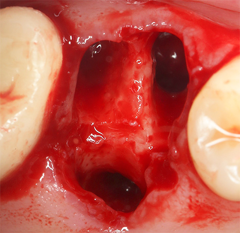 Ας μιλήσουμε για κάποια σημαντικά σημεία σχετικά με τη διακοπή του αίματος μετά τη διαδικασία εξαγωγής δοντιών ...