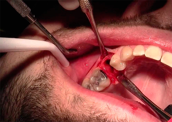 Η αιμορραγία μπορεί να αυξηθεί εάν ο γιατρός πρέπει να ανοίξει την πληγή πολύ μακριά για καλύτερη πρόσβαση στις ρίζες του δοντιού.