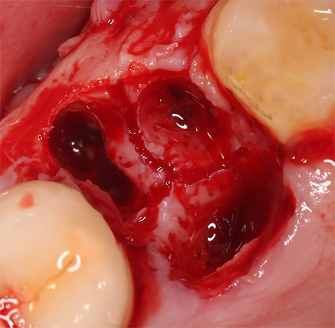 Η φωτογραφία δείχνει μια νέα τρύπα αιμορραγίας στην περιοχή του εξαγόμενου δοντιού.