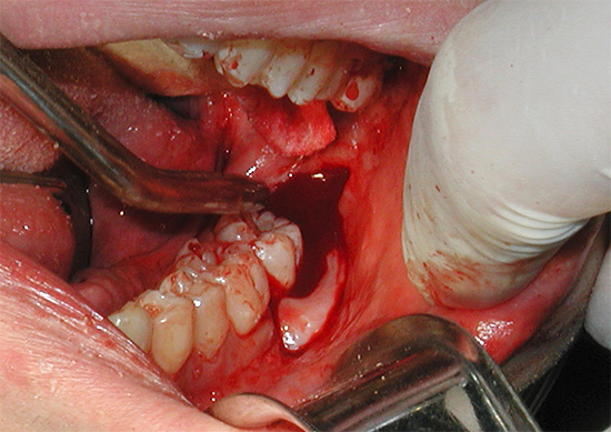 Μερικές φορές, όταν εξάγεται ένα δόντι, ο γιατρός τραυματίζει πολύ τον ιστό των ούλων, πράγμα που επιπλέον προάγει την αιμορραγία.