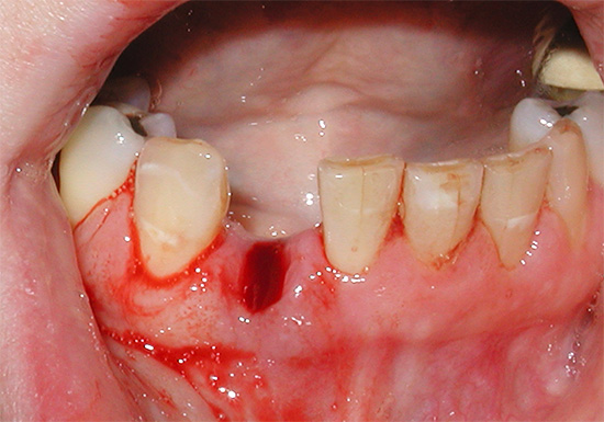 Κανονικά, η αιμορραγία μετά την εκχύλιση των δοντιών πρέπει να σταματήσει μετά από 10-30 λεπτά.