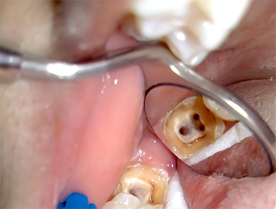 Hablemos sobre las características del tratamiento de la pulpitis de dientes de tres canales y los precios de este procedimiento en las modernas instituciones dentales ...