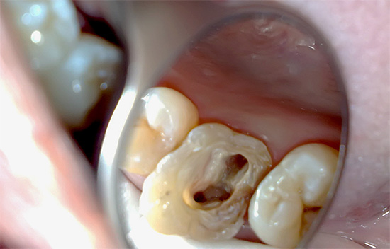 El precio para el tratamiento de la pulpitis de un diente de tres canales suele ser bastante alto, debido a la mayor complejidad del trabajo, así como al aumento del tiempo y los costos de material.