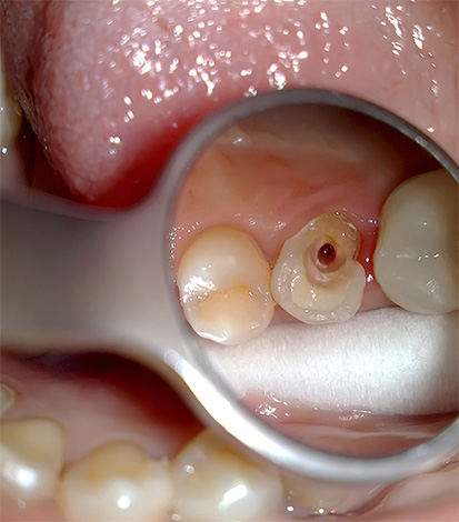 La foto muestra el tratamiento de pulpitis de un solo canal del diente.
